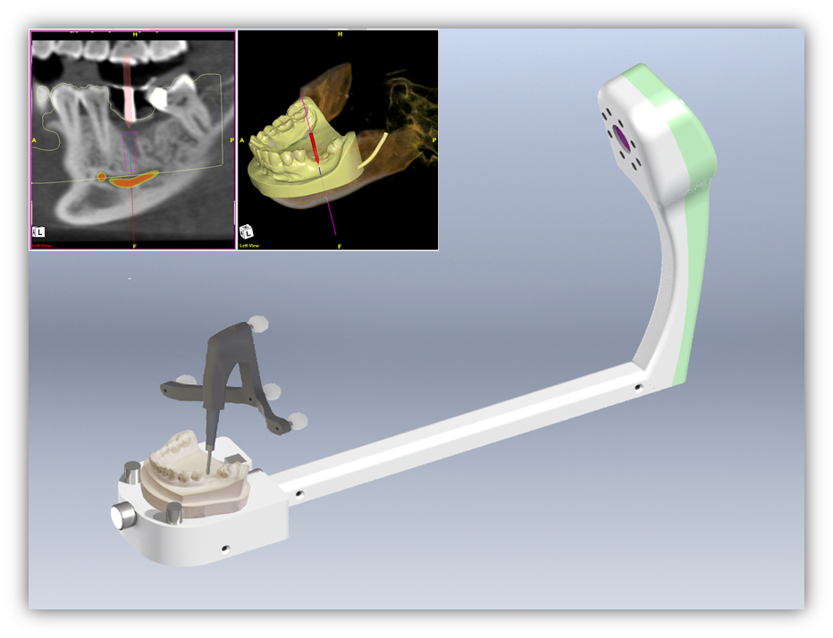 dental_impalntmax